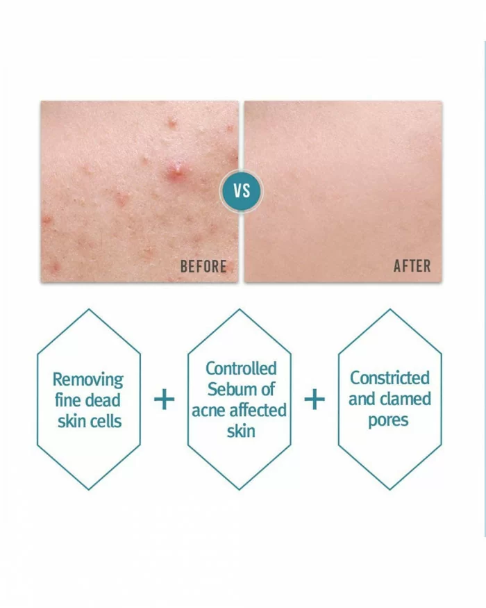 Acne Toner