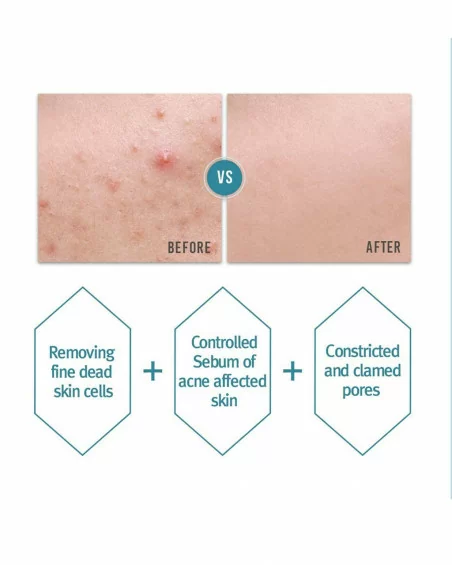 Acne Toner