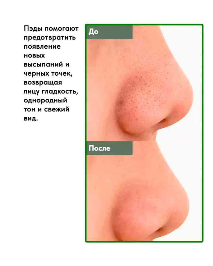 2% Salicylic Acid Clear Pad